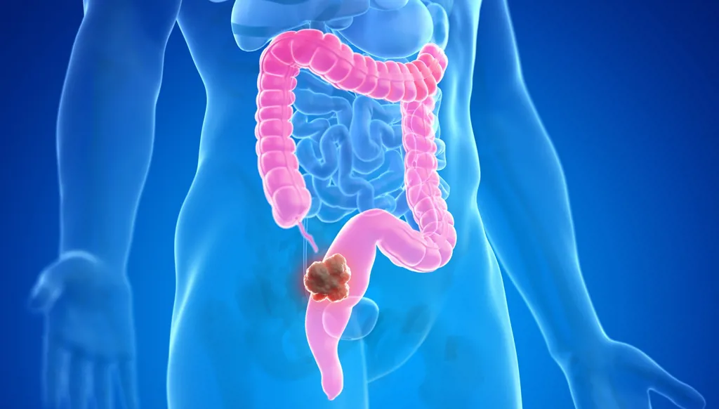 سبب وفيات السرطان في أميركا: سرطان القولون