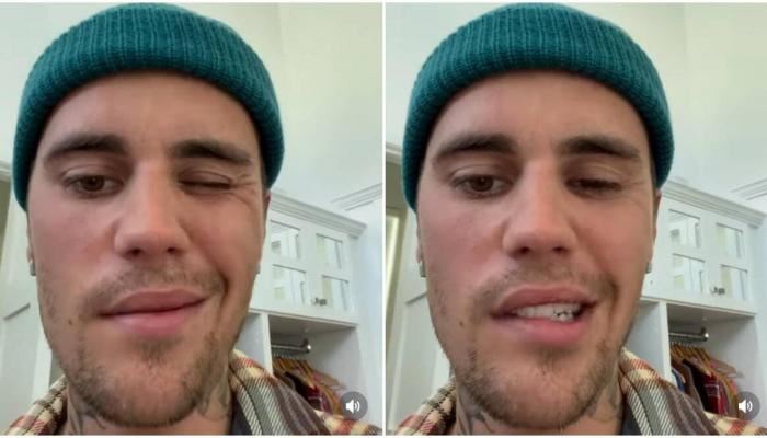 بالفيديو: شلل نصفي يُصيب جاستن بيبر... ما هي متلازمة رامسي-هانت وما عوارضها؟