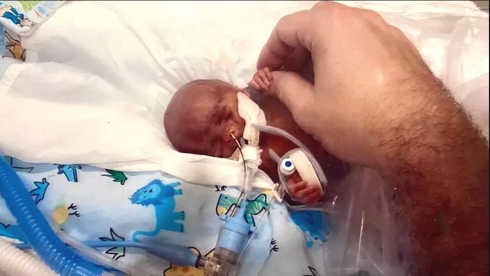 الطفل المعجزة: توقَّع الأطباء أن يعيش يوماً... والآن يحتفل بعامه الأول
