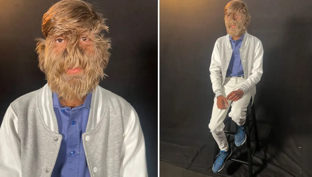 مراهق هندي يحطّم الرقم القياسي لأكثر الوجوه كثافة في الشعر