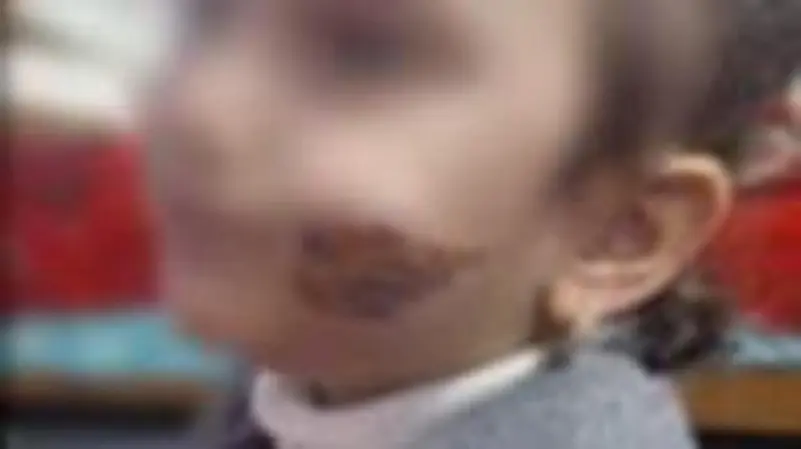 صورة للطفلة (إكس).