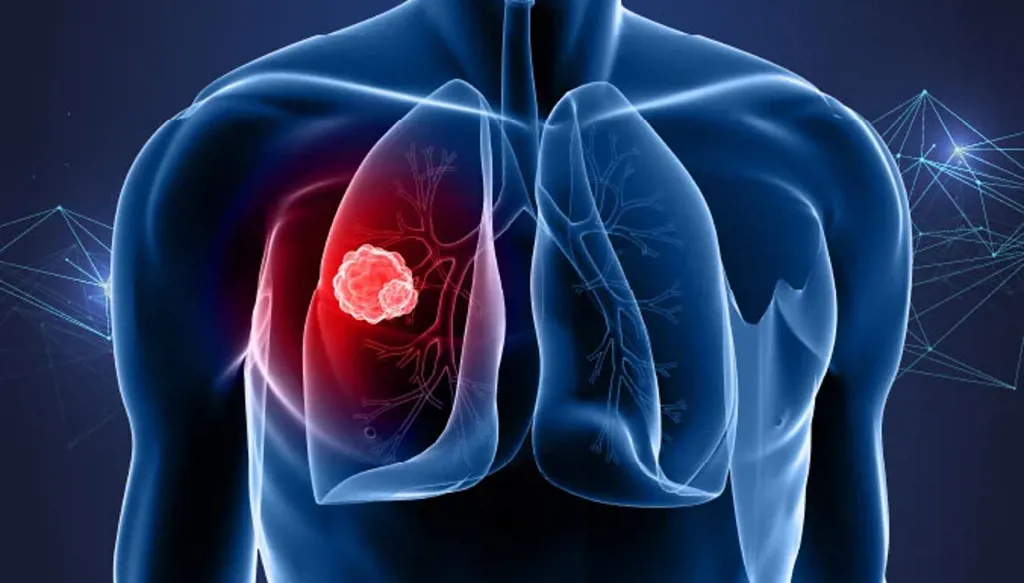 شهر التوعية بسرطان الرئة... الوقاية أسهل الطرق لتجنبه