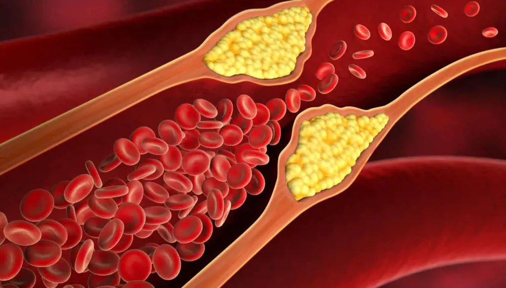 علامات تنذر بارتفاع مستويات الكوليسترول في الدم