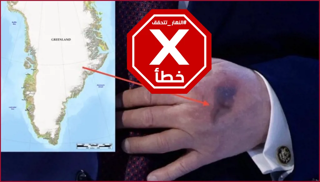 الكدمة على يد ترامب علامة من الله والنبوءة لا بد من أن تتحقق؟ النهار تدقق FactCheck