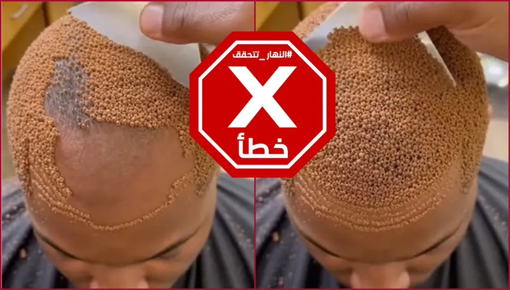 فيديو يروّج لأحدث صرعة... بيض السمك لعلاج الصلع؟ النهار تتحقق FactCheck