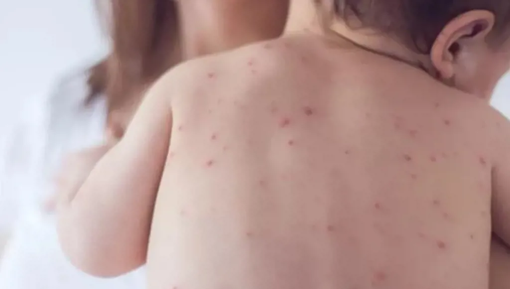 وسط تفشٍ غير مسبوق... حالات الحصبة ترتفع إلى 370 في تكساس ونيو مكسيكو بأميركا