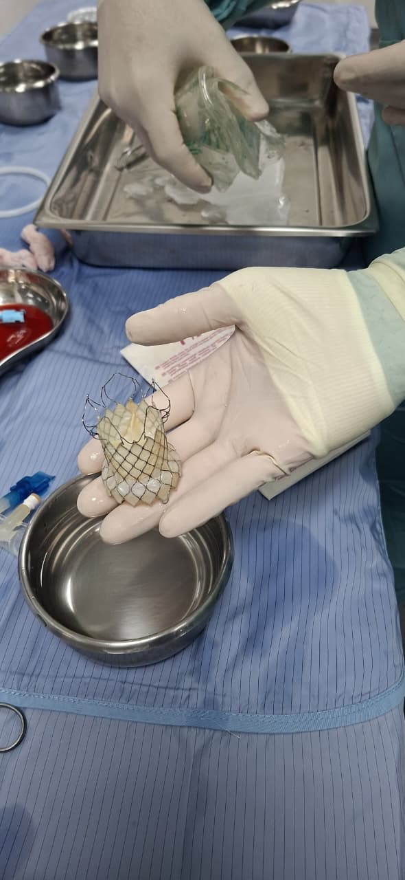 زرع صمام رئوي من خلال الجلد