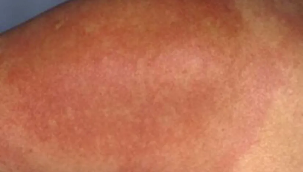 أول لقاح مضاد لمرض "لايم"