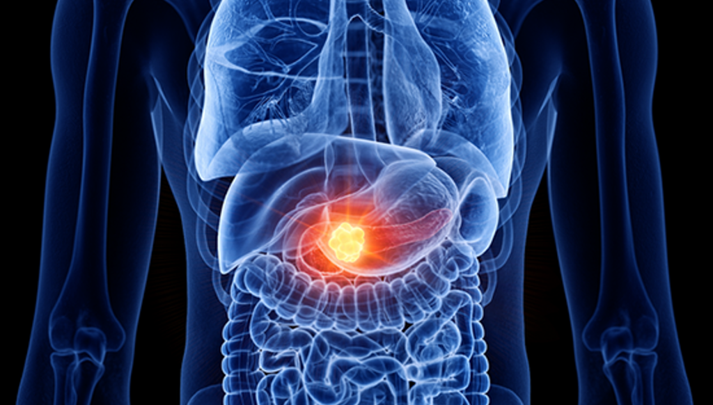 شهر التوعية بسرطان البنكرياس... علامة غريبة تنذر بالخطر