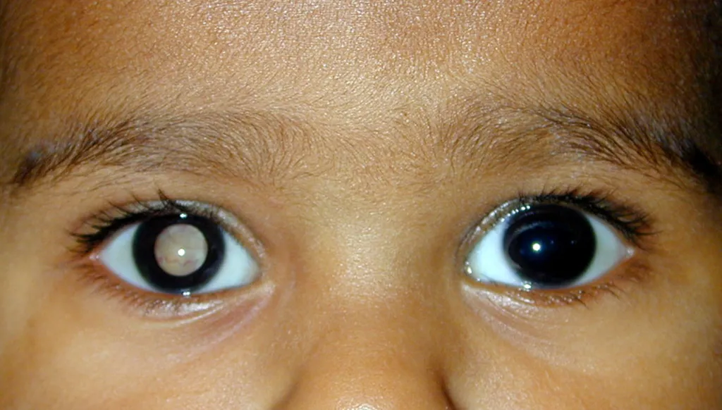 سرطان العين والماء الأزرق...حالتان مختلفتان والعارض واحد