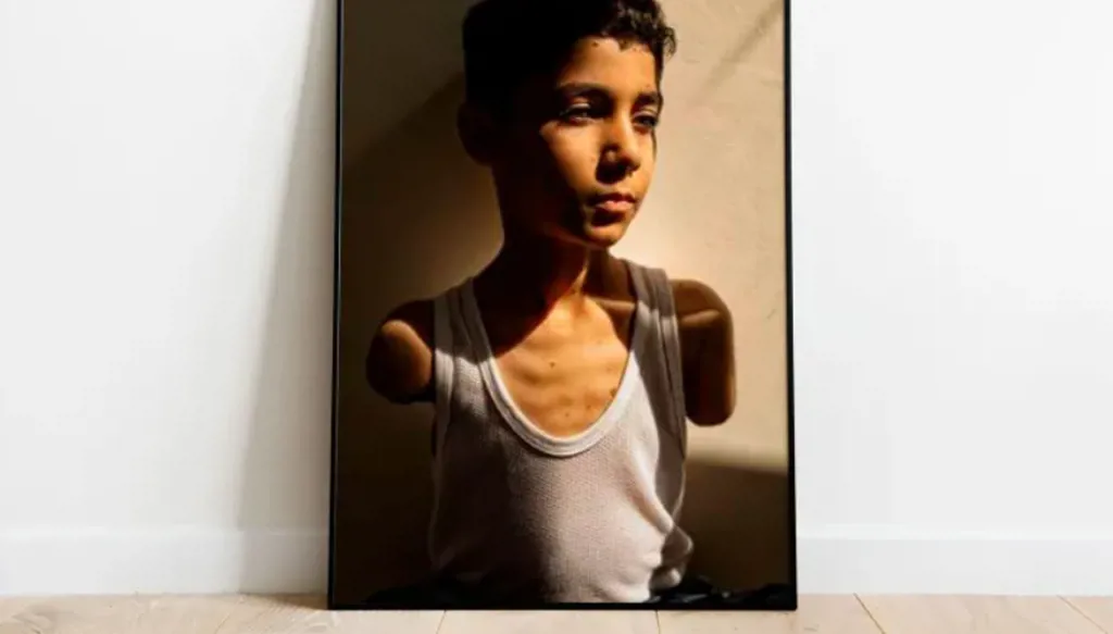 صورة طفل فلسطيني بترت ذراعاه تفوز بجائزة الصحافة العالمية