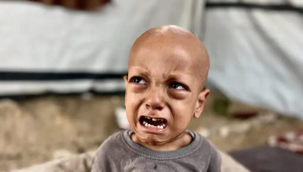 طفل غزّة عبدالله أبو زرقة الذي صرخ "أنا جوعان"...  يفارق الحياة في تركيا (فيديو)