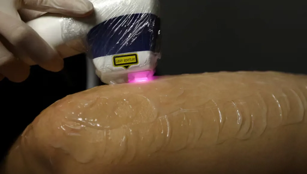 في اليابان... حرارة الصيف تنعش عيادات إزالة الشعر للرجال