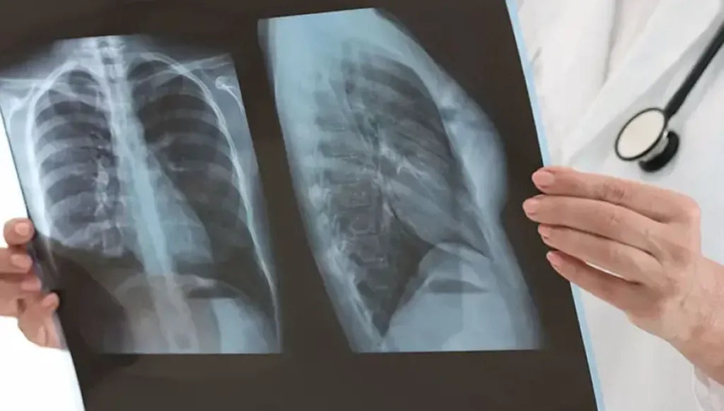 شهر التوعية عن سرطان الرئة... الوقاية ممكنة وفي غاية السهولة