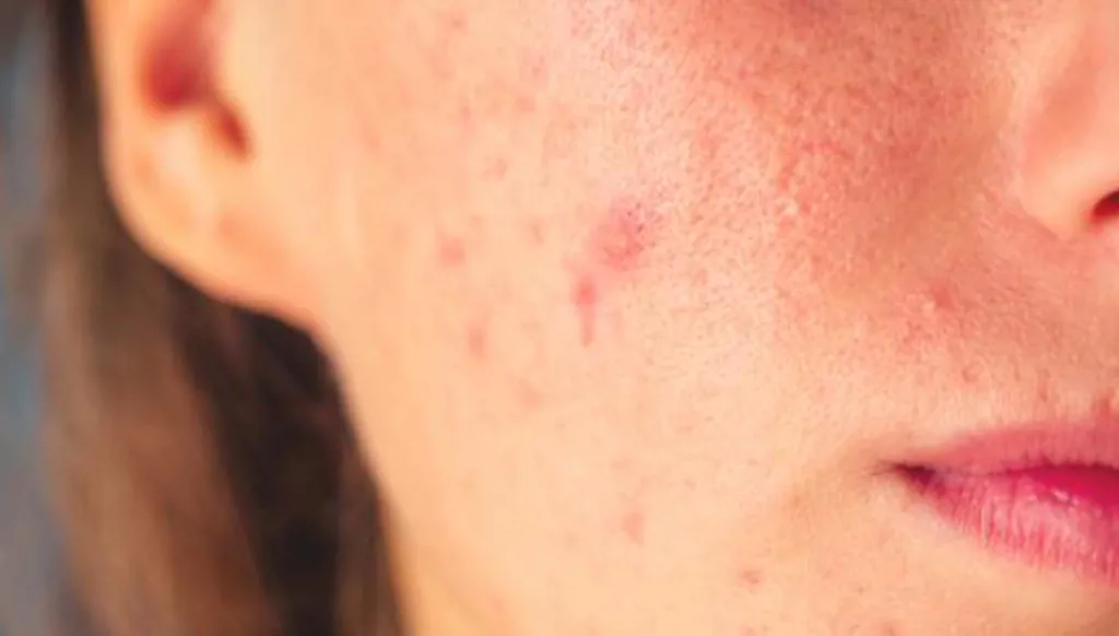 علامات تدل على ارتفاع معدلات الهرمونات الذكورية لدى المرأة