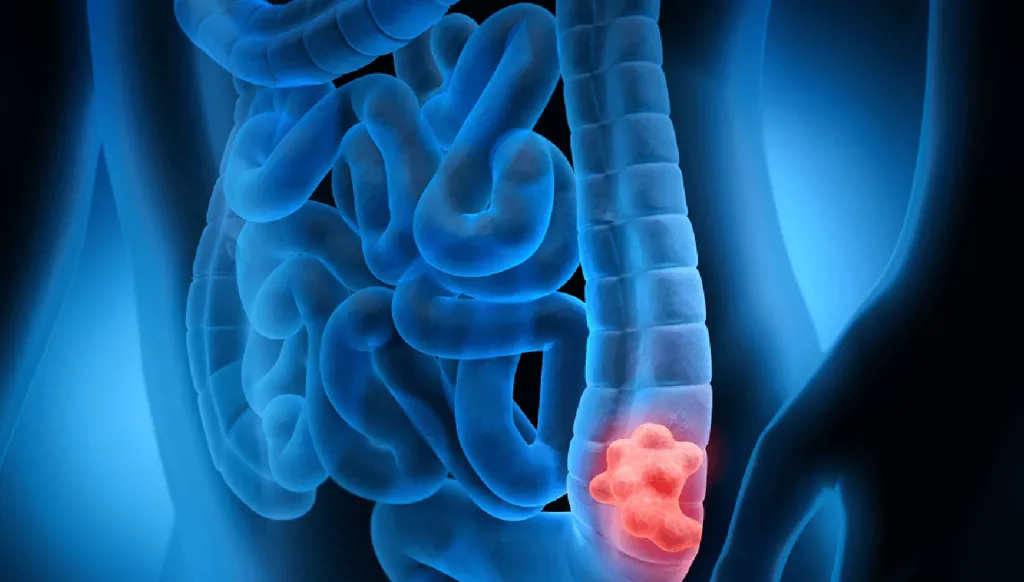 سرطان القولون من الأكثر انتشاراً... وقابلية للوقاية منه!