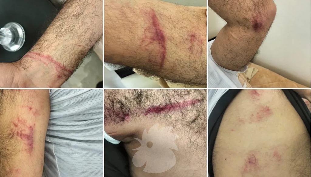 آثار الضرب والكدمات على أجساد فلسطينيين عقب العملية العسكرية الإسرائيلية في مخيم قلنديا. (النهار)