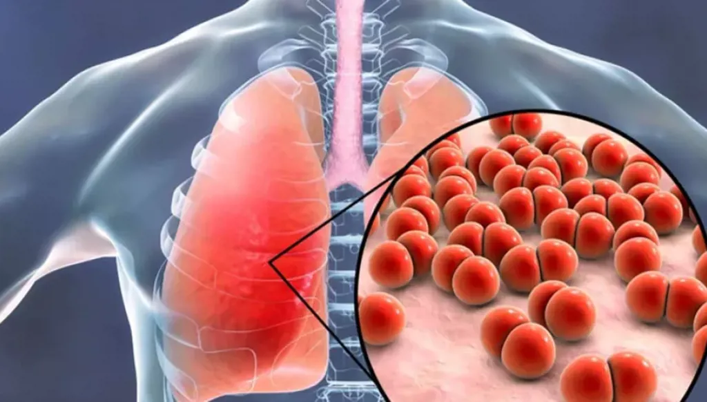 انخفاض معدلات الإصابة بالسل لأول مرة منذ "كورونا"