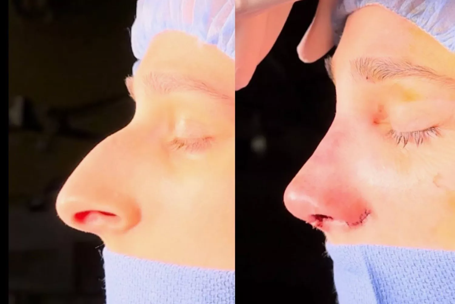 ديفين أيكن قبل عملية تجميل الأنف وبعدها. (المصدر: ديفين أيكن)