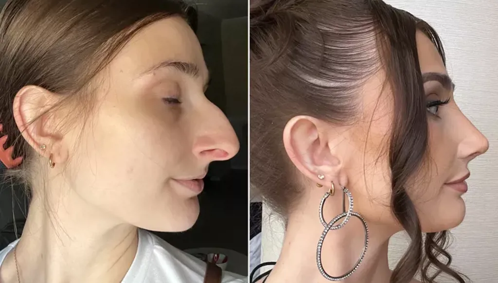 جراحة  تجميل أنف بقيمة 11 ألف دولار تغيّر حياة امرأة... طلقت زوجها؟