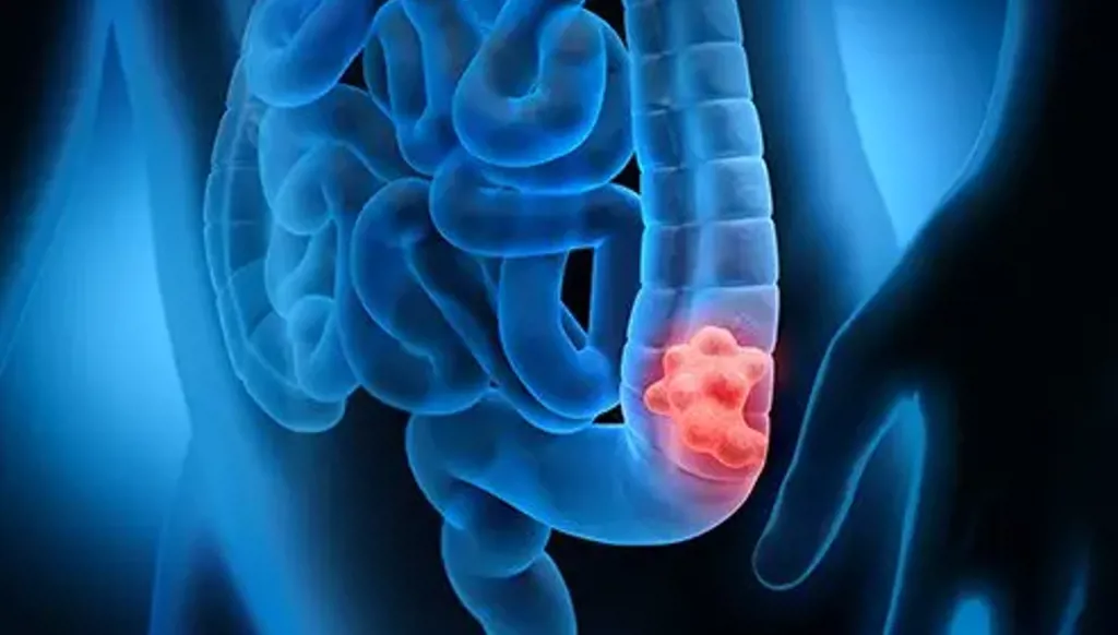 5 عادات تزيد خطر الإصابة بسرطان القولون قبل سن الخمسين