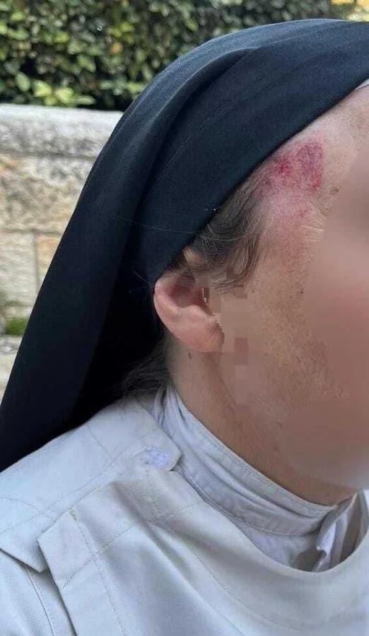 صورة تُظهر كدمات على الجانب الأيمن من وجه الراهبة.