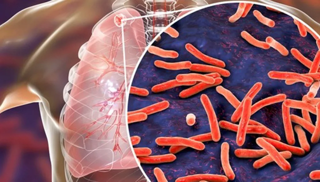 ارتفاع الإصابة بالسلّ لدى الأطفال في دول الاتحاد الأوروبي