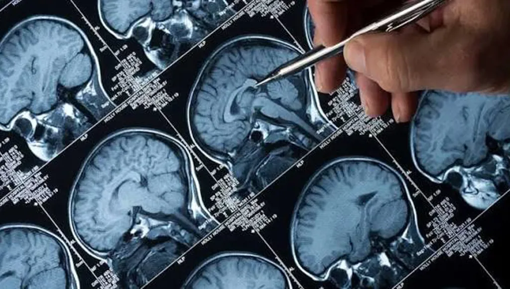 العلاج بالرنين المغناطيسي المتكرر... حل فعّال لمواجهة الاكتئاب