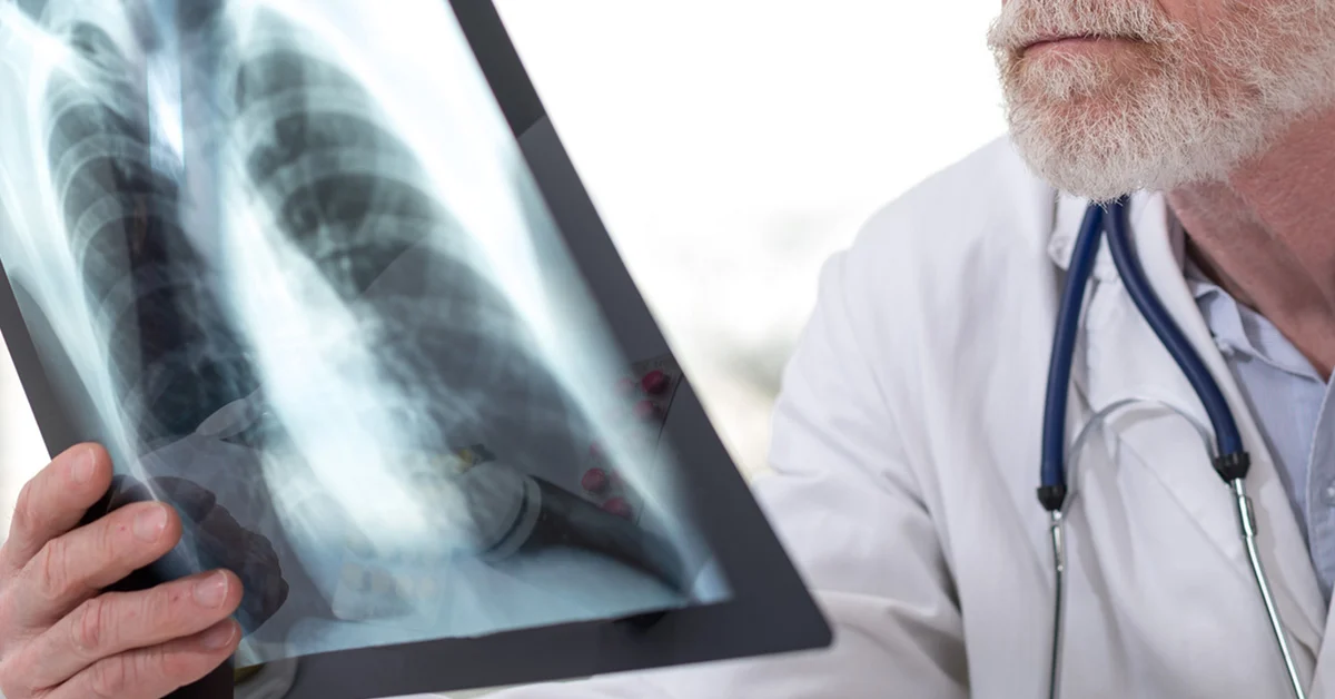 الكشف المبكر عن سرطان الرئة