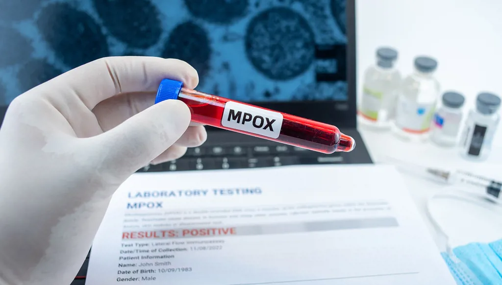 كوسوفو ترصد أول إصابة بجدري القردة