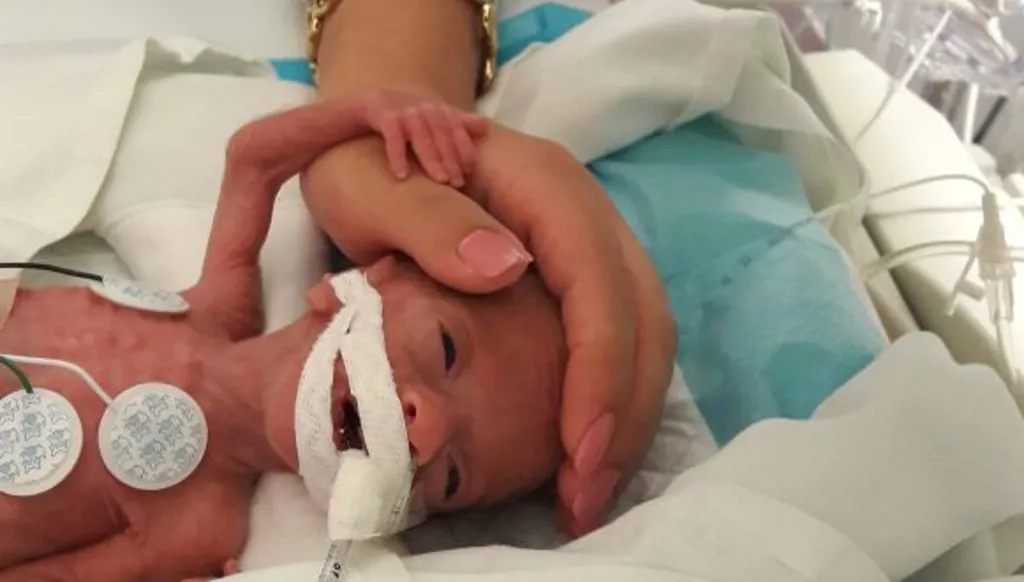 410 غرامات من الحياة… قصة بيتر أصغر طفل ولد في لبنان وعاش (فيديو)