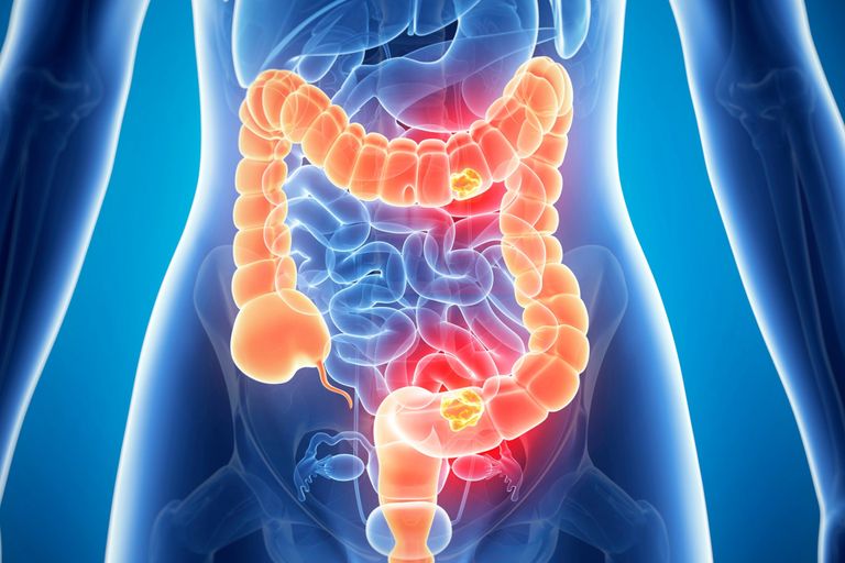 أمراض الجهاز الهضمي لدى الشباب باتت ظاهرة منتشرة 