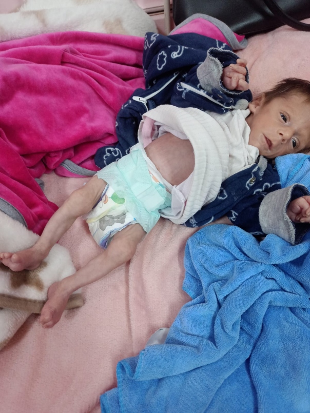 طفل من غزة يعاني من سوء التغذية (تصوير: الدكتور أحمد الفرا)