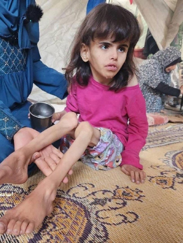 طفلة من غزة تعاني من سوء التغذية (تصوير: الدطتور احمد الفرا)