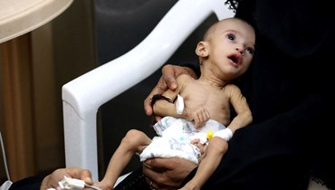 صورة لطفل يعاني من سوء تغذية في مركز علاجي في محافظة الحديدة غرب اليمن (15 شباط 2022، أ ف ب). 
