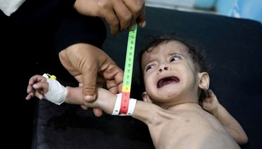 طفل يعاني سوء تغذية يتلقى العلاج في مركز في مدينة تعز اليمنية (6 آذار 2022، أ ف ب). 