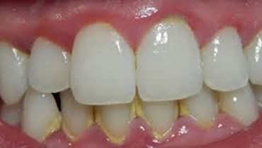 جير الأسنان 