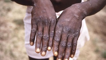صورة تعود لعام 1997 قدمتها مراكز السيطرة على الأمراض والوقاية، وتظهر شخصا مصابا بجدري القرود في جمهورية الكونغو الديمقراطية (أ ب).