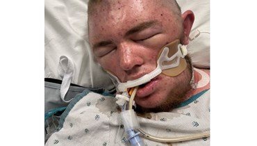 الشاب الأميركي في المستشفى بعد تعرّضه لأكثر من 20 ألف لسعة نحل.