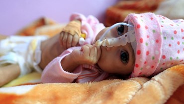 طفل يعاني سوء تغذية في صنعاء (أ ف ب).