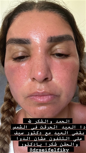 روجينا تصاب بحروق وتورم في الوجه بسبب أشعة الشمس وتحذر جمهورها