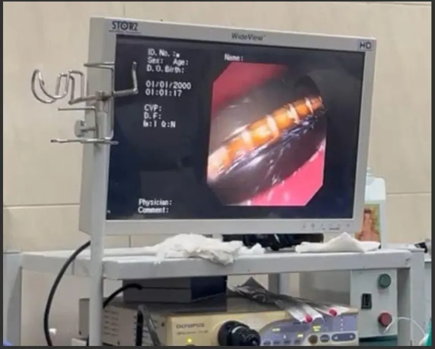 In pictures – phone pulled out of man’s stomach 5 months after swallowing!