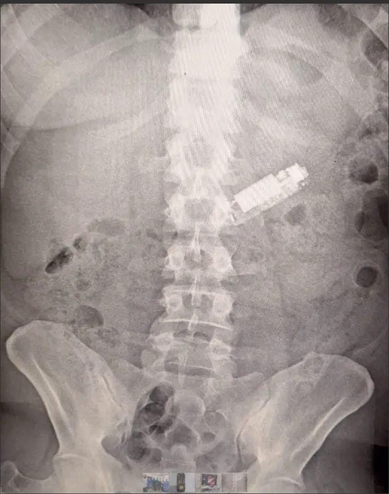بالصور- استخراج هاتف من معدة رجل بعد 5 أشهر من ابتلاعه!